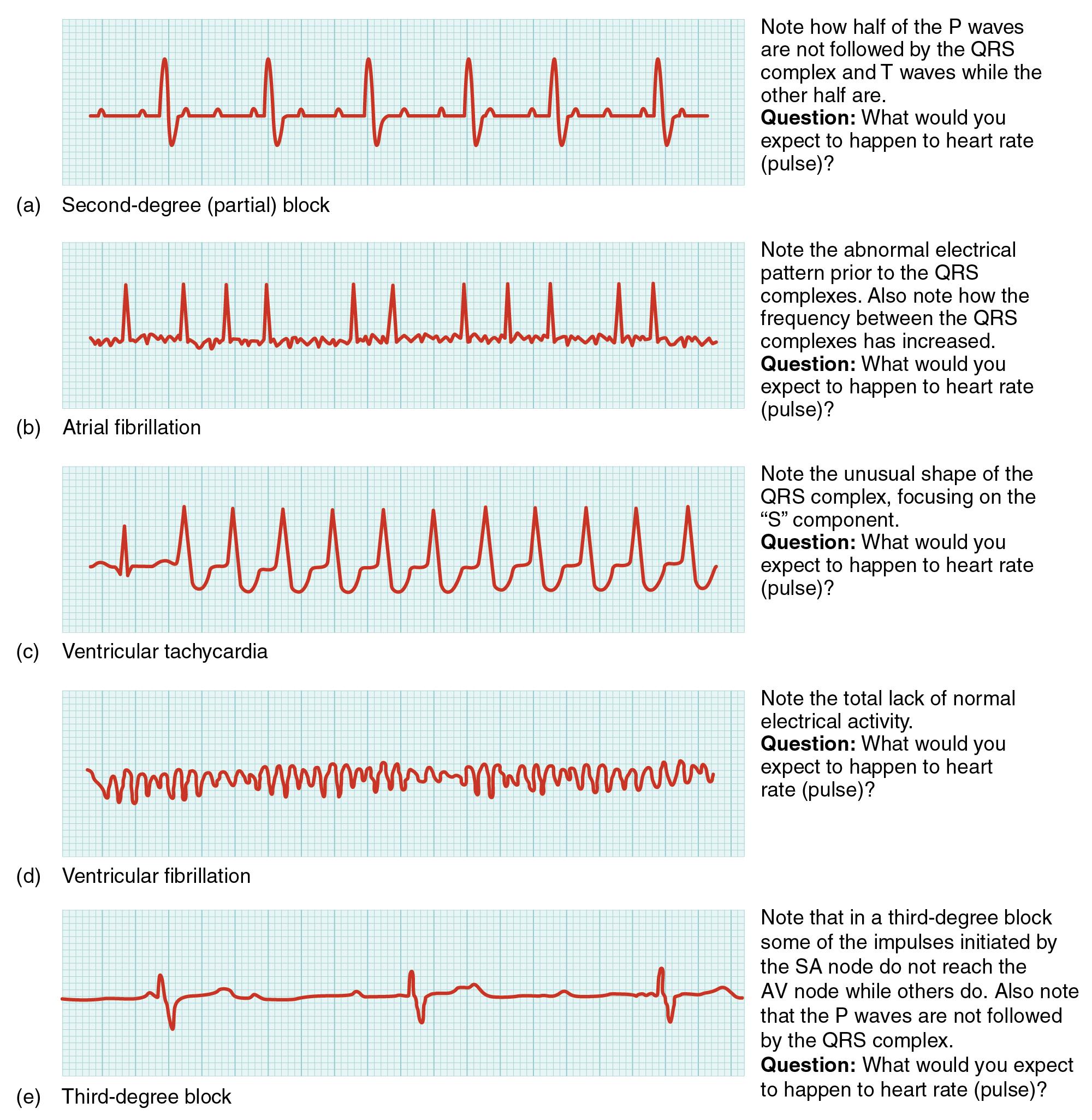 Recognizing Irregular Heart Rhythms: ⁤Insights from⁤ Apple’s Latest Technology